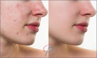 Acne_and_scars_retouchup